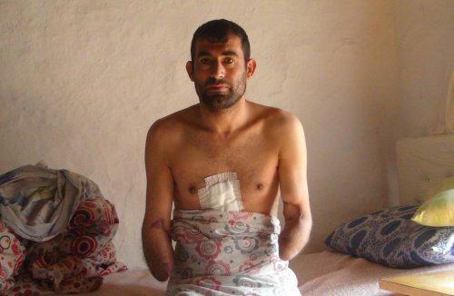 İki kolunu kaybeden inşaat işçisi, protez kol hayali kuruyor