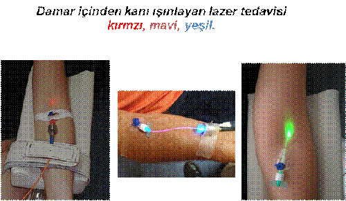 Kalp Damar Hastalarina Mujde