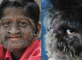 Milyarda 1 görülen hastalığın pençesinde