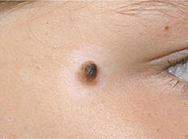 Benler kanser habercisi mi?