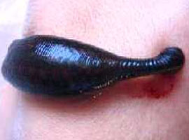 Boğazından canlı sülük çıktı  