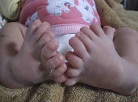 16 parmaklı bebek dünyaya geldi !