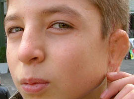 Göğüs kafesinden kulak kepçesi