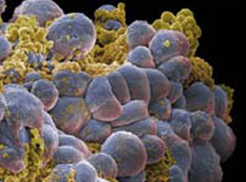 Aşama aşama göğüs kanseri	