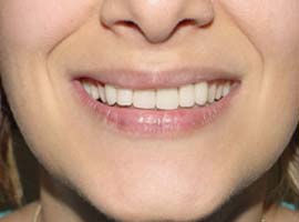 Diş sağlığında doğru bilinen 8 yanlış