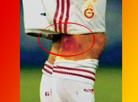 Arda'nın bacağı delindi ! - Foto