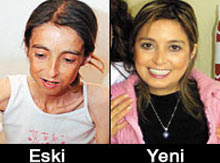 Manken hastalığından nasıl kurtuldu?