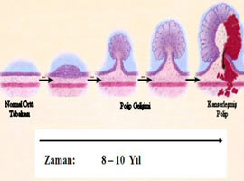 Şarap bağırsak kanserini tetikliyor
