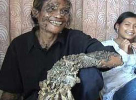 'Ağaç adam' görenleri şaşırtıyor - Foto