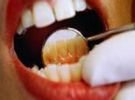 Çürük diş, kalp hastalıklarını tetikliyor  